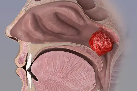 اللحمية البلعومية