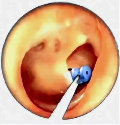 تجمع السوائل في الأذن