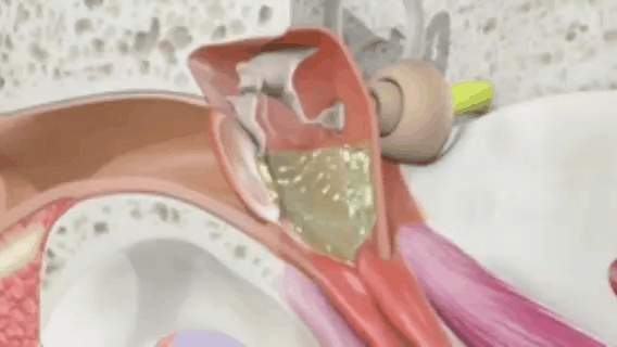 عملية زراعة الأنبوب