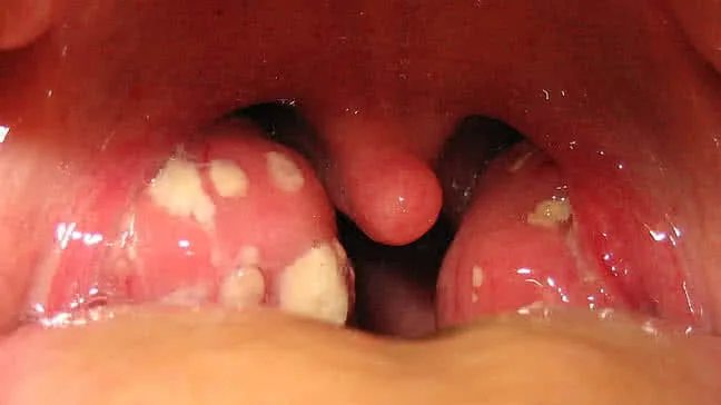 عملية اللوزتين