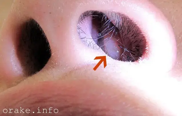 لحميات الأنف