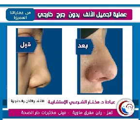 نتيجة تجميل الأنف1 6