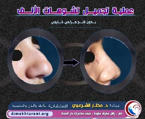 نتيجة تجميل الأنف1 6
