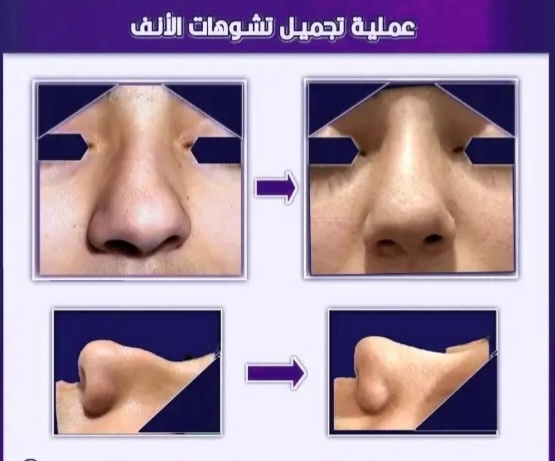 5 نتيجة تجميل الأنف 